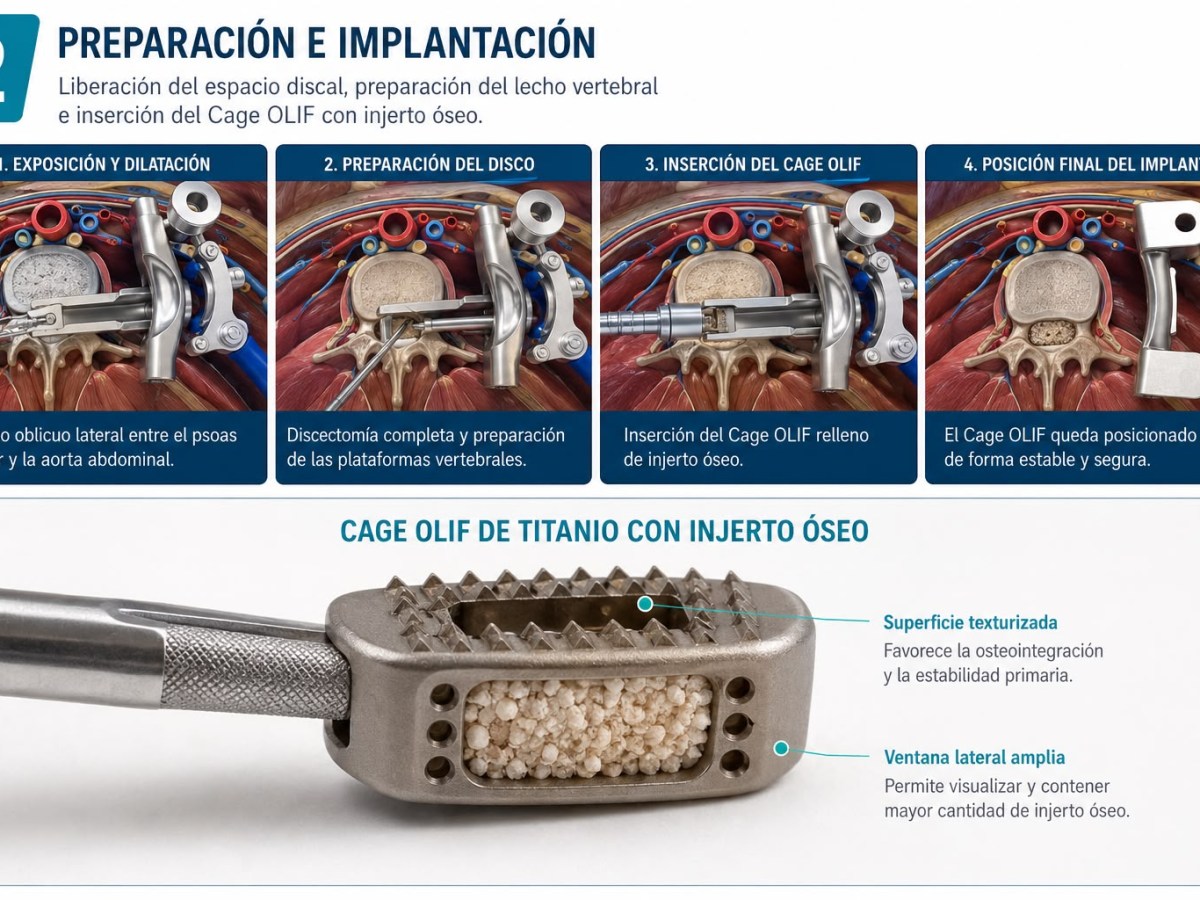 NUEVA TÉCNICA PARA CIRUGÍAS DE COLUMNA LLEGA A ECUADOR Y AMPLÍA LAS OPCIONES PARA PACIENTES CON DOLOR LUMBAR