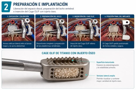 NUEVA TÉCNICA PARA CIRUGÍAS DE COLUMNA LLEGA A ECUADOR Y AMPLÍA LAS OPCIONES PARA PACIENTES CON DOLOR LUMBAR